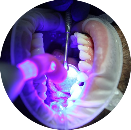 Das Bild zeigt die Bestrahlung einer Keramikfüllung mit blauem UV-Licht.
